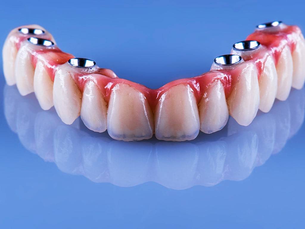 Implant dentaire : une dent déterminante ?